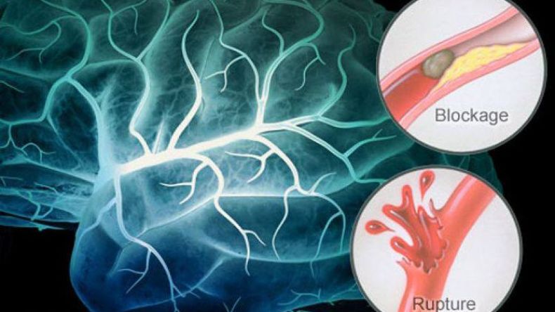 50 ألف إصابة جديدة بالجلطة الدماغية سنويا في الجزائر