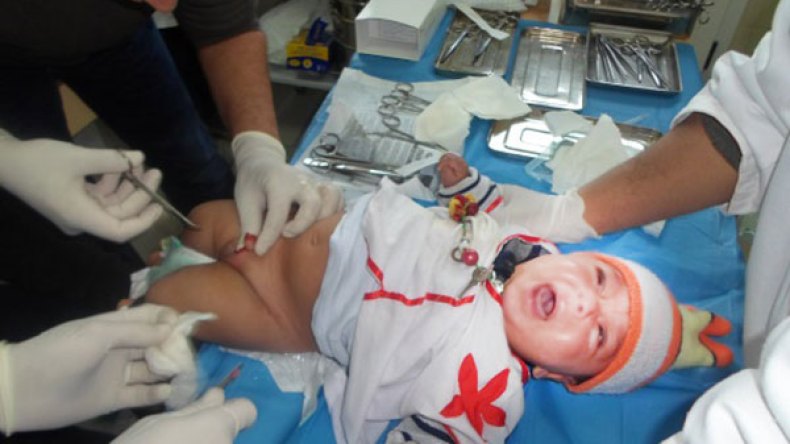 التخدير الجزئي ممنوع في عمليات الختان