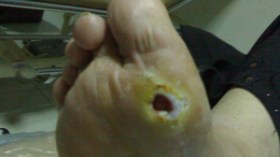 “هيبر بروت 75” دواء فعال لعلاج قرحة قدم السكري وتفادي بترها