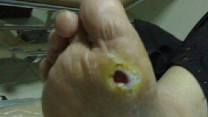 “هيبر بروت 75” دواء فعال لعلاج قرحة قدم السكري وتفادي بترها