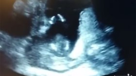 جنين “يصفق” داخل رحم أمه