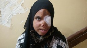 حروق شوهت وجه الطفلة بركاهم” وعائلتها تستغيث