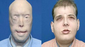 متبرع يهب وجهه لرجل إطفاء في أكبر عملية زراعة للوجه