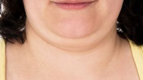 إذا كنت تعانين من “الذقن المزدوج” فإليك الحل!