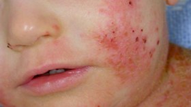 الحليب والبيض والكاكاو أهم الأغذية المسببة للحساسية عند الجزائريين