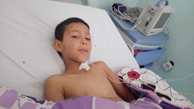 بتر يد طفل وقدم آخر في انفجار جسم غريب بأم البواقي