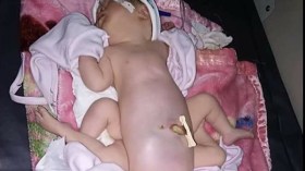 الجزائر تعجز عن فصل توأمين ملتصقين