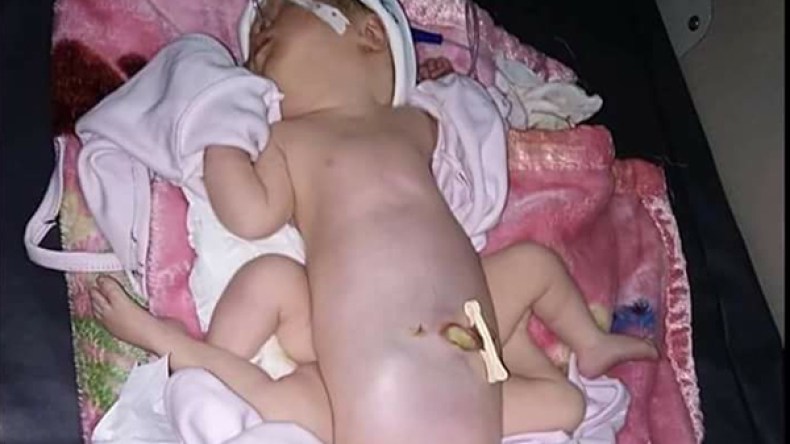 الجزائر تعجز عن فصل توأمين ملتصقين