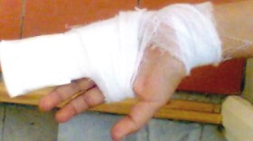 معلمة تكسر يد تلميذة لأنها لم تنجز واجبها المنزلي