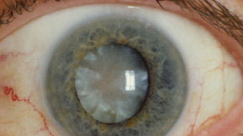 “الماء الأزرق” يهدد مليوني جزائري بالعمى بعد الأربعين