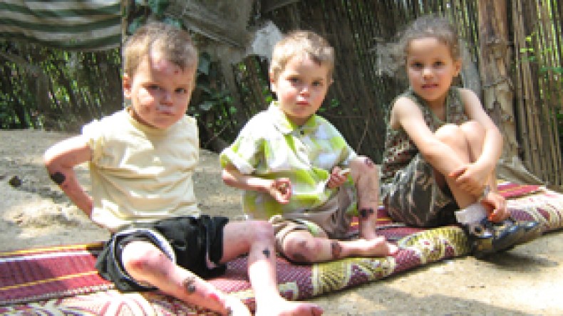 مرض جلدي نادر ينهش جسمي الصغيرين محمد أمين وعبد الغني والفقر زاد في بأسهما