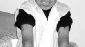 »جلد ثعبان« يكسو فاتح منذ 9 سنوات