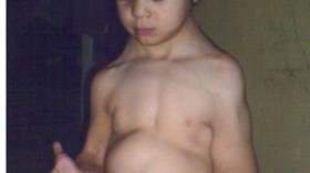 انتفاخ غريب يصيب جسدها.. ظهرها.. وكفها يزن 1 كلغ