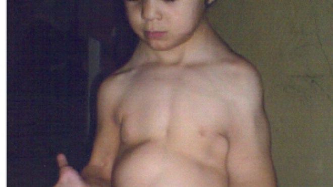 انتفاخ غريب يصيب جسدها.. ظهرها.. وكفها يزن 1 كلغ