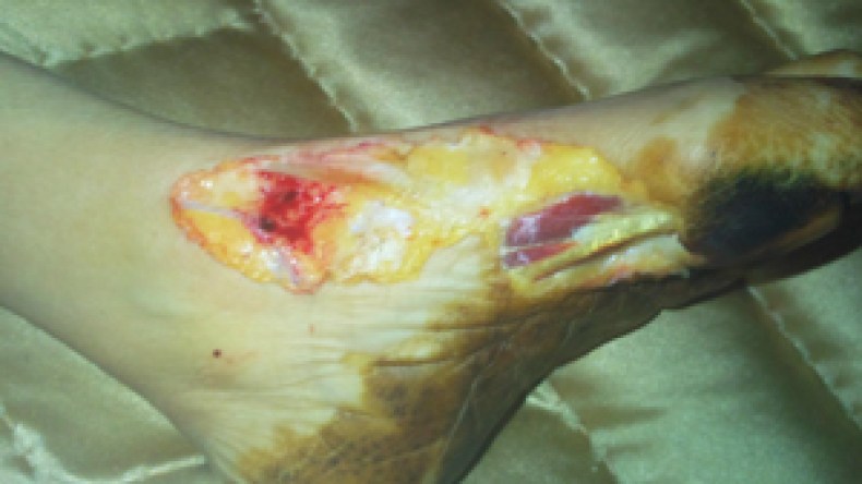 سيدة تموت بالسل ثم تُسلخ قدمها بشكل وحشي في المَشرحة!