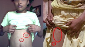 امرأة تكوي بنات زوجها بكماشات حديدية