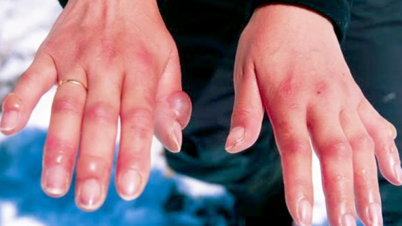 “عضة الصقيع” أخطر مرض شتوي يتجاهله الجزائريون