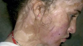 قارورة غاز حولت حياة الصغيرة نوال إلى جحيم