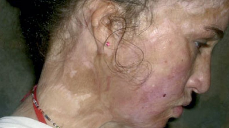 قارورة غاز حولت حياة الصغيرة نوال إلى جحيم