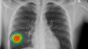 منظومة جديدة للذكاء الاصطناعي لرصد النتائج غير الطبيعية في الصور الشعاعية