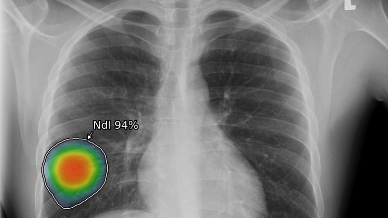 منظومة جديدة للذكاء الاصطناعي لرصد النتائج غير الطبيعية في الصور الشعاعية