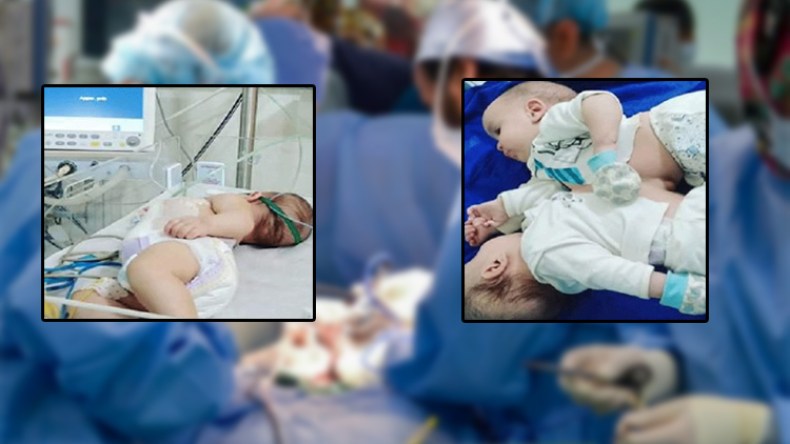 نهاية مأساة التوائم الملتصقين في الجزائر