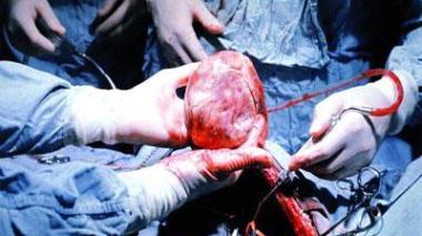 Insuffisance rénale : la dialyse coûte 200 millions par an pour une seule personne