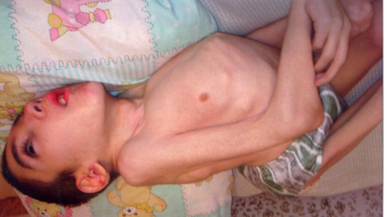 طفل في السابعة يزن 6 كلغ بسبب الفاليوم