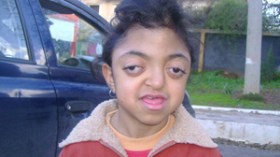 الطفلة “وعد حنين” بحاجة إلى سبع عمليات جراحية بالخارج