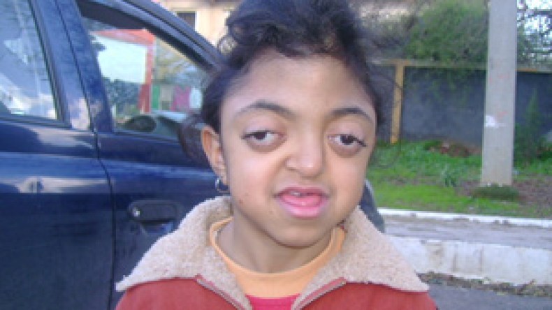 الطفلة “وعد حنين” بحاجة إلى سبع عمليات جراحية بالخارج