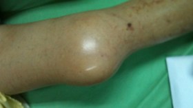 3500 حالة هيموفيليا بالجزائر لا يتكفل بهم سوى 13 مستشفى عبر الوطن