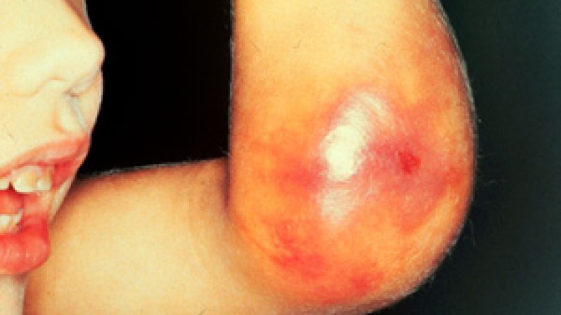 ألفا شخص مصاب بالهيموفيليا بالجزائر مهددون بالإعاقة والموت