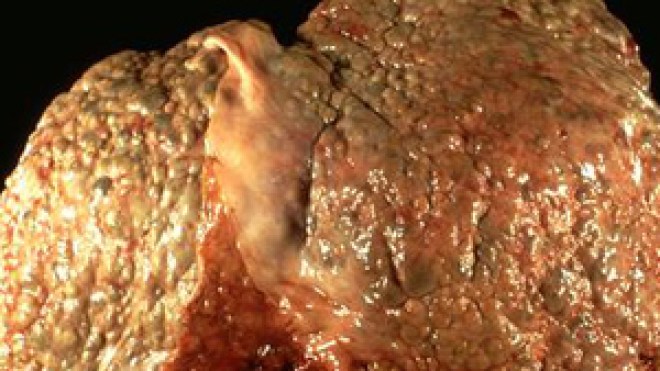 مليونا جزائري أصيبوا بإلتهاب الكبد الفيروسي عند جراحي الأسنان