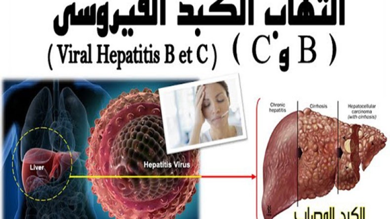 ابتكار جزائري لعلاج التهاب الكبد الفيروسي”س”