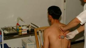 سبعون بالمئة من مستعملي الحجامة مهدّدون بالسيدا