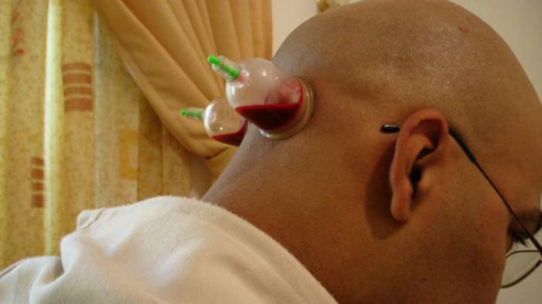 طلبة البكالوريا يقبلون على الحِجامة