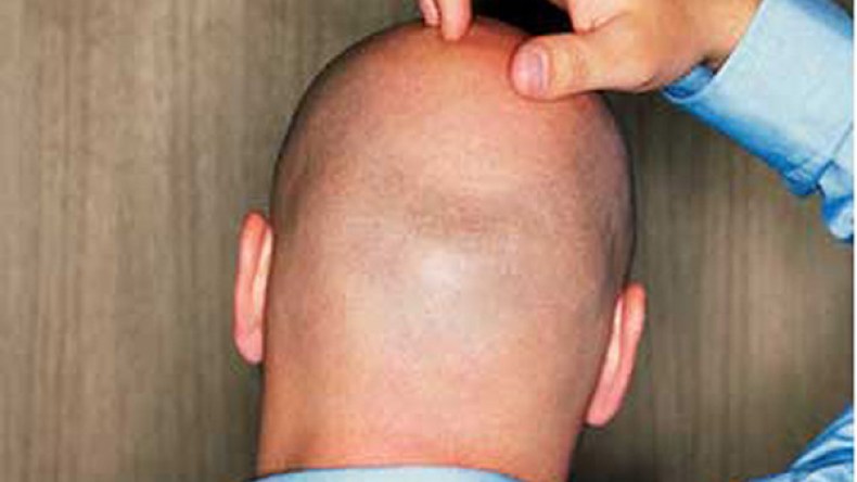 مصرية تخلع زوجها بسبب الصلع