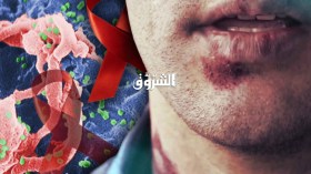 12 ألف جزائري مُصاب بالسيدا و800 مريض سنويا!