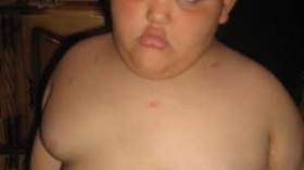 صبيّ في الخامسة يزن 80 كيلوغراما!