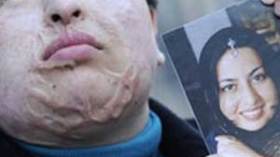 إيرانية تعفو عن شاب شوهها بالحامض  وتترك عقابه لله