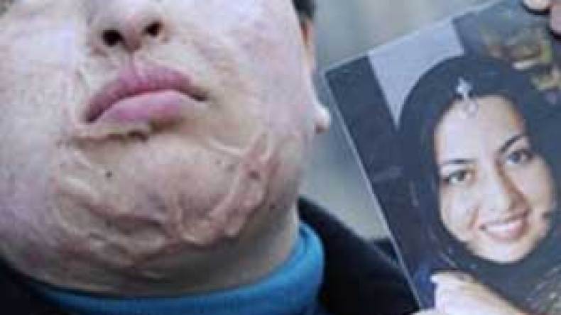 إيرانية تعفو عن شاب شوهها بالحامض  وتترك عقابه لله