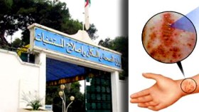 ظهور حالات جرب يثير الطوارئ بمستشفى تقصراين بالعاصمة
