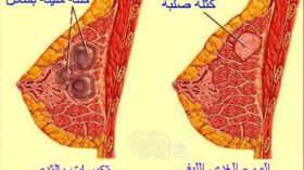 هل تؤدي هذه التكيسات للإصابة بالسرطان؟