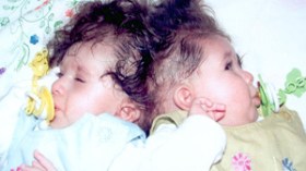 “زكاة” و”سلسبيل” التوأم الملتصق الذي أعياه عجز مستشفياتنا