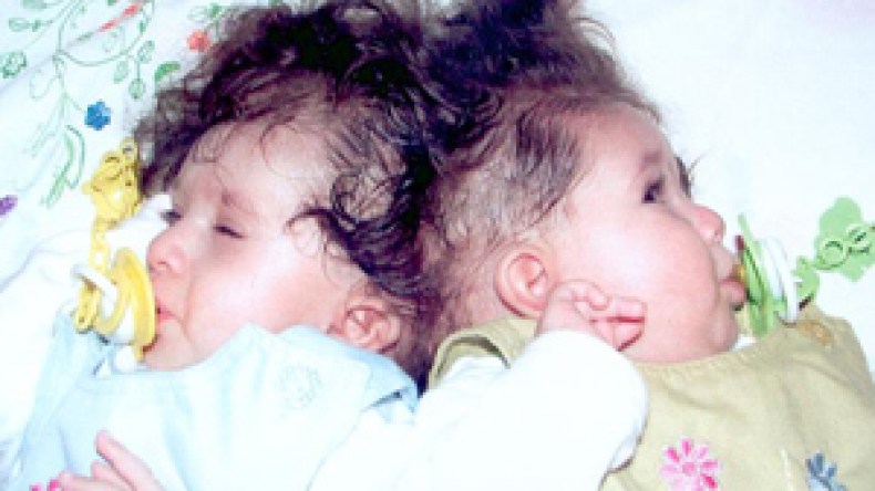 “زكاة” و”سلسبيل” التوأم الملتصق الذي أعياه عجز مستشفياتنا