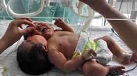 ولادة توأم بجسم واحد ورأسين والأطباء يعجزون عن فصله