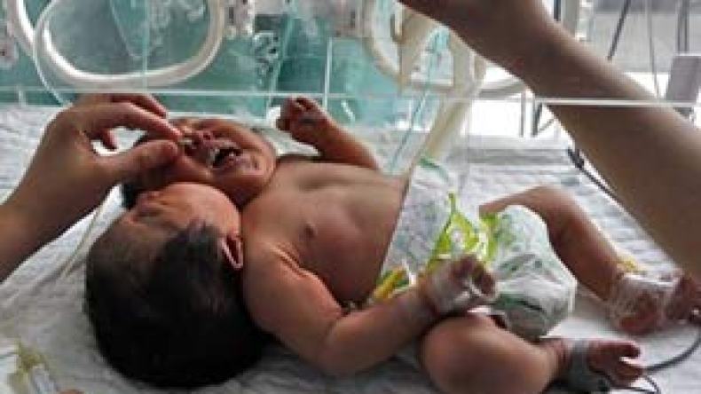 ولادة توأم بجسم واحد ورأسين والأطباء يعجزون عن فصله