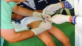 الأطباء العامون ممنوعون من ختان الأطفال و3500 جرّاح للختان الفردي والجماعي