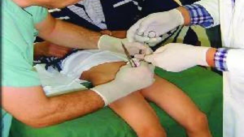 الأطباء العامون ممنوعون من ختان الأطفال و3500 جرّاح للختان الفردي والجماعي