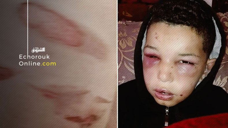 طفل يتيم يتعرض للكي والصعق بالكهرباء في قسنطينة